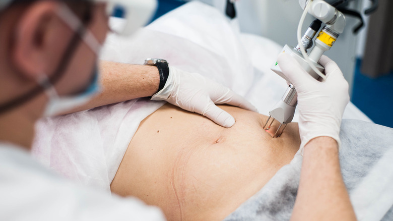 doctor makes laser treatment of stretch marks