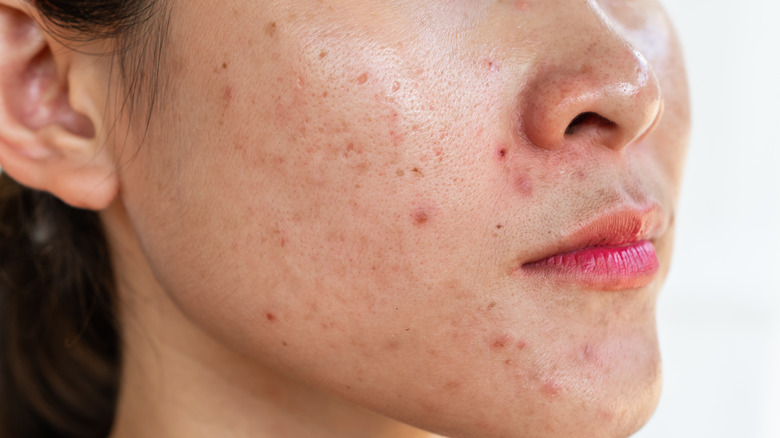 woman with acne