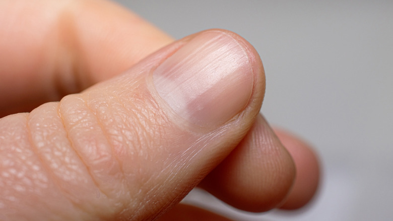 Thumb nail with vertical ridges