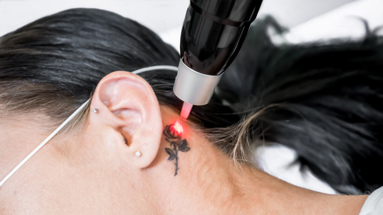 tattoo removal process