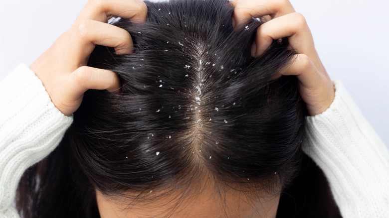 hair with dandruff