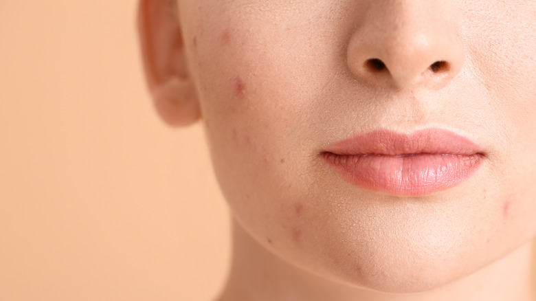 Woman with acne