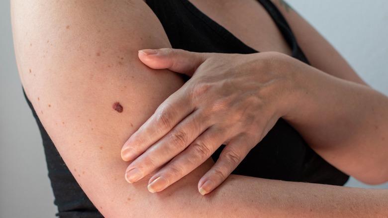 Person touching arm with mole 