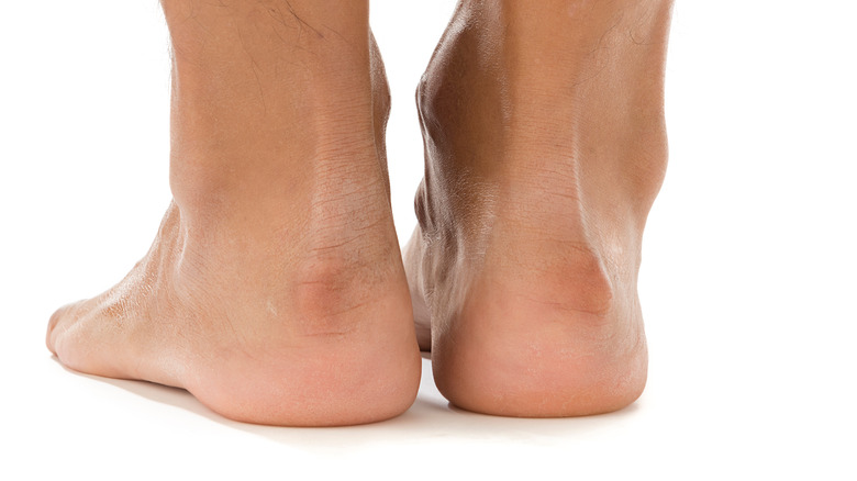 Person with bone enlargement in heels