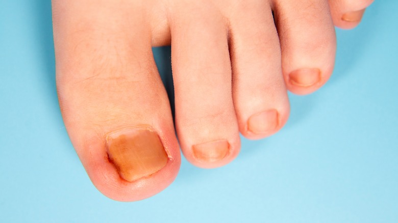 Ingrown toenail