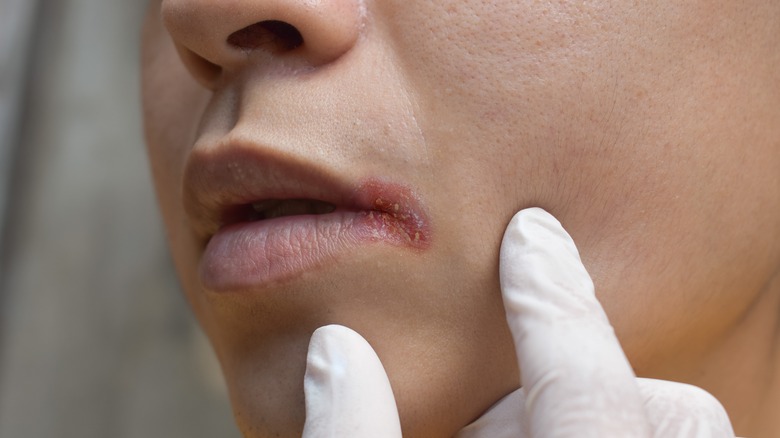 Doctor inspecting cracked lip corners