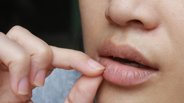 Girl with cracked lips