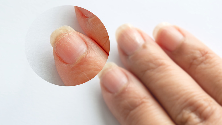 A person with unhealthy nails