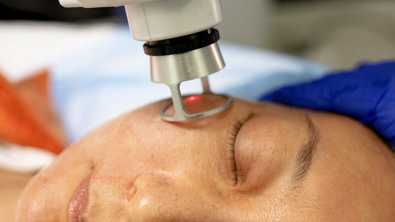 woman with hyperpigmentation tan skin