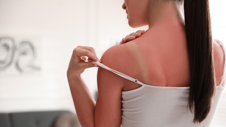 Woman with sunburned back