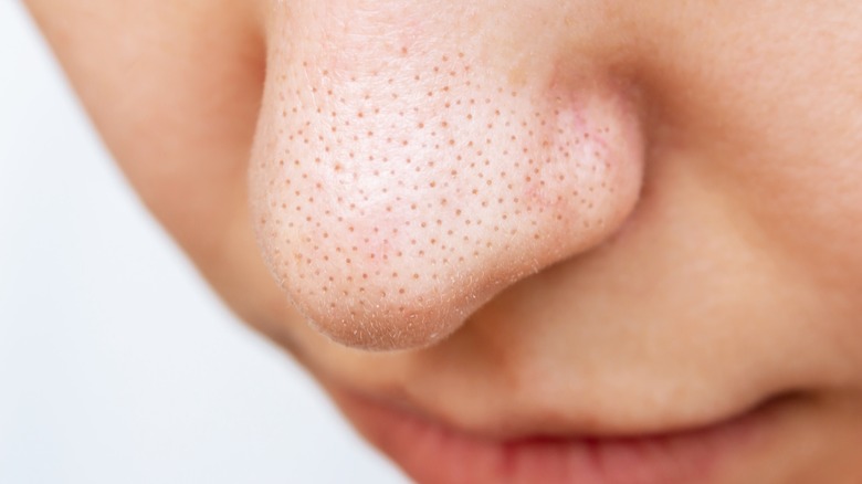Blackheads on a nose