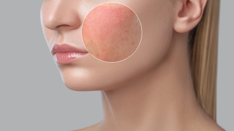 Zoomed in red facial skin