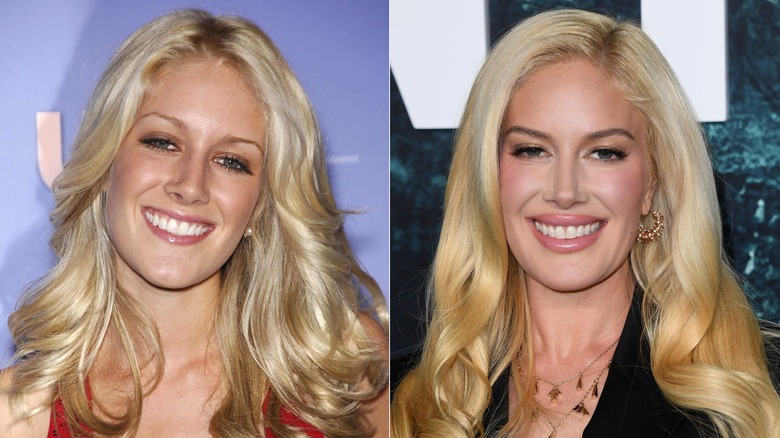 Heidi Montag looking natural in 2007 and with cosmetic enhancements in 2011