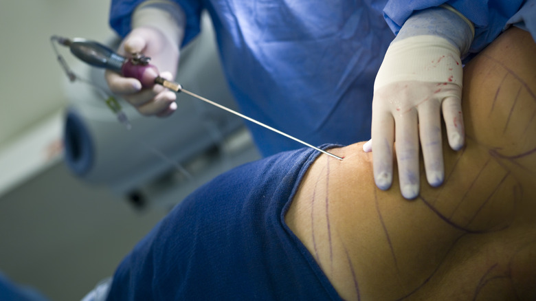 A plastic surgeon performing liposuction