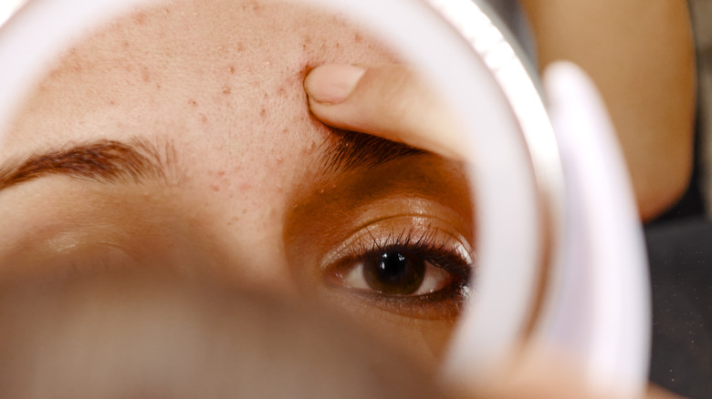 Girl inspecting her acne