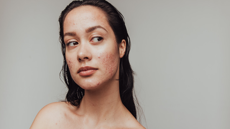 Woman with acne