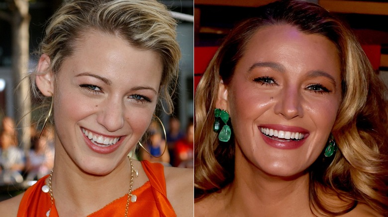 Blake Lively's teeth before she had them done, and afterwards