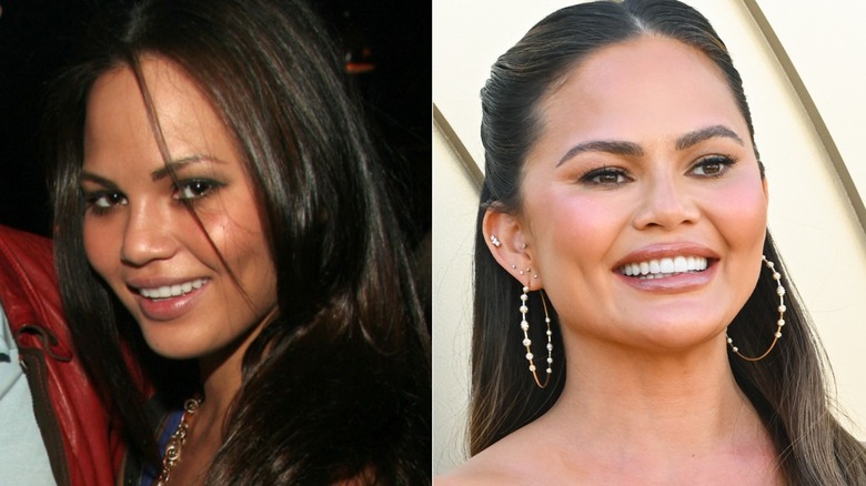 Chrissy Teigen's teeth before and after, where they're noticeably bigger and whiter
