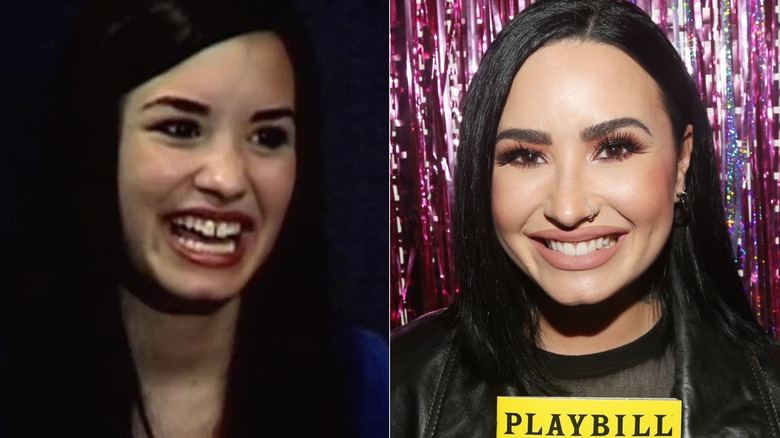 Demi Lovato's teeth before -  gapped - and after - white and straight