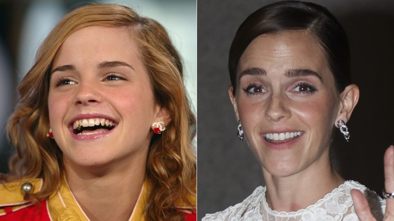 Emma Watson's teeth before she got veneers and afterwards