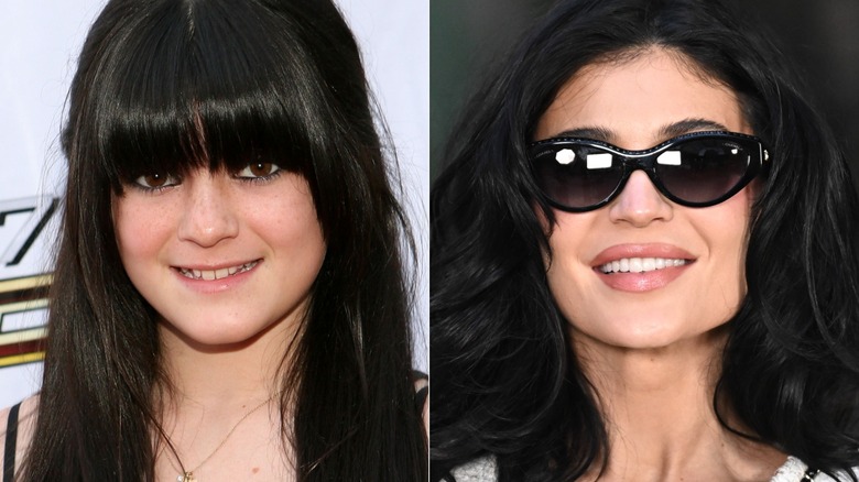 Kylie Jenner's teeth before when she was young and after when they're straight and uniform