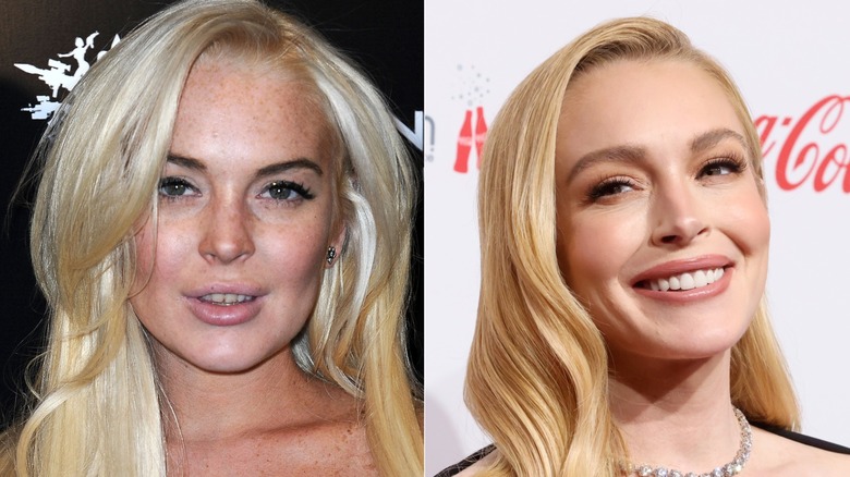 Lindsay Lohan's teeth before - stained and chipped - and after - white and even