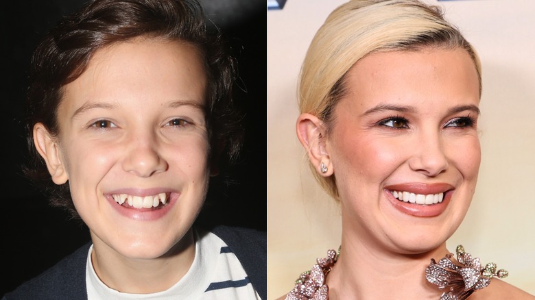 Millie Bobby Brown's teeth before - crooked and uneven - and after veneers