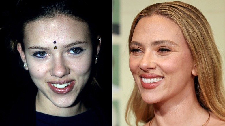 Scarlett Johansson's teeth before she had them done and afterwards