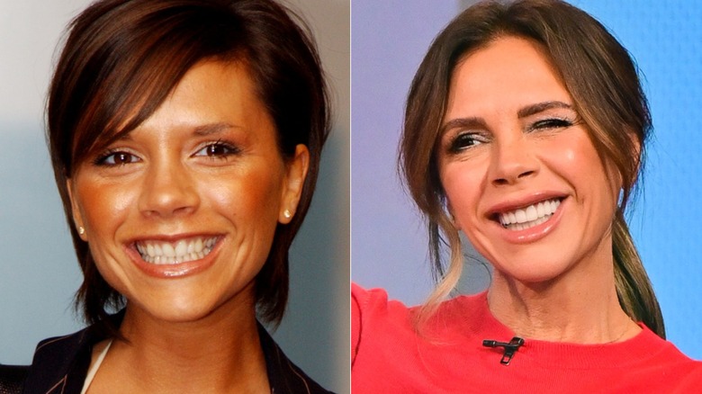 Victoria Beckham's teeth before and after getting veneers