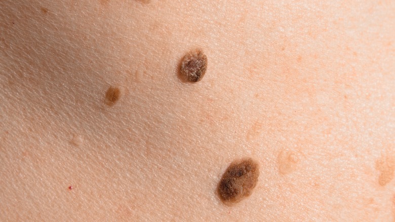 Close up of skin with several large moles