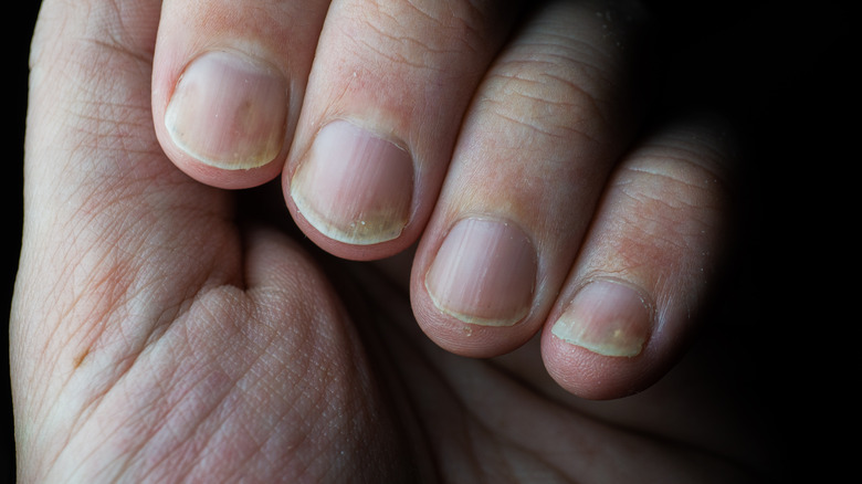 Hand with yellow nails