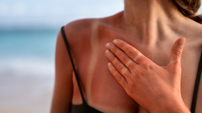 A woman with a sunburn