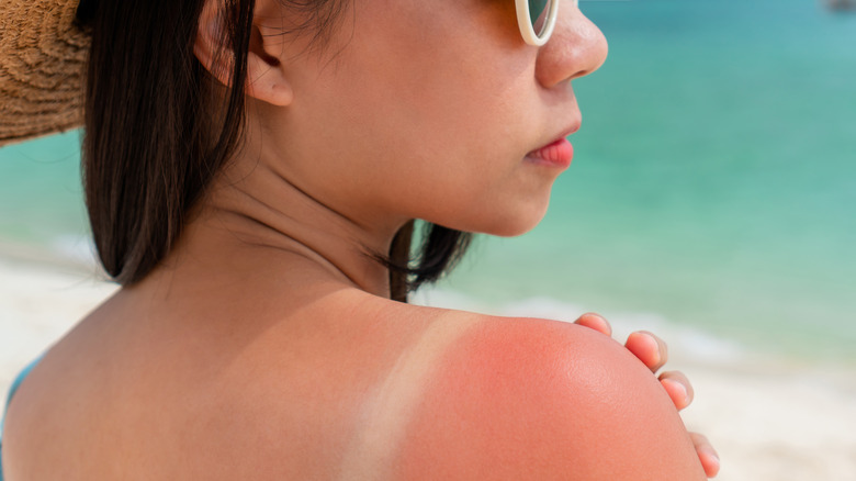 Woman with sunburned shoulders