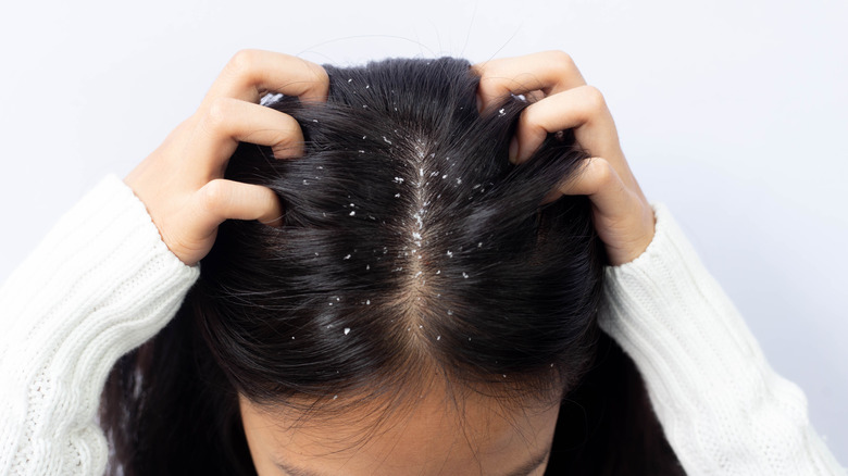 A scalp with dandruff