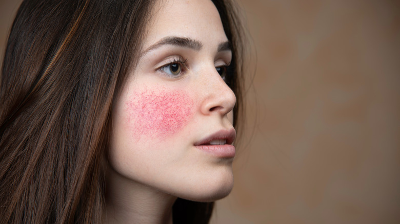 Woman with rosacea on her cheek