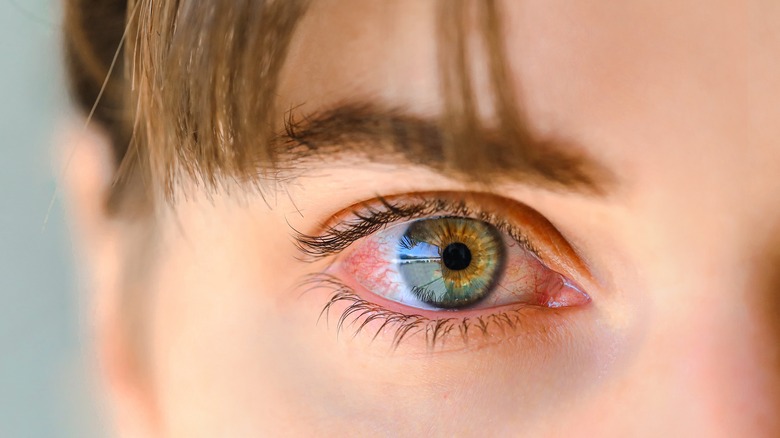 A woman with irritated eye