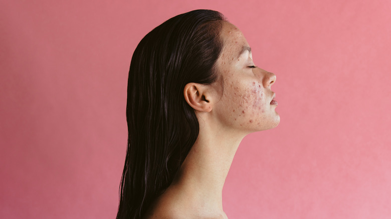 A woman with acne
