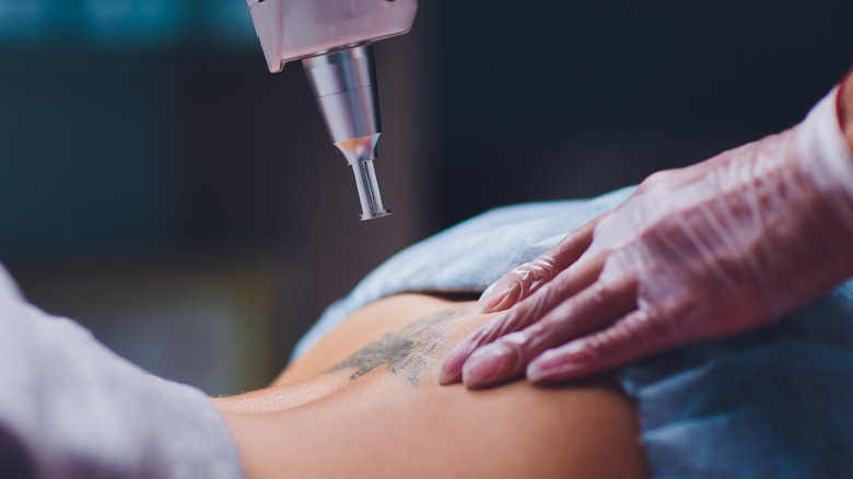 laser removing tattoo on back