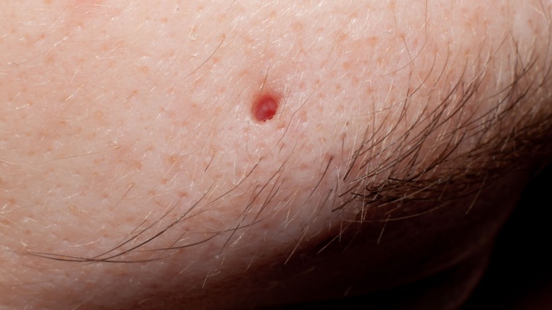 Eyebrow piercing hole without jewelry