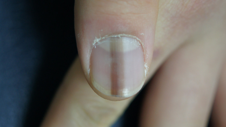 discolored nail