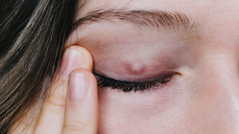 eyelid chalazion