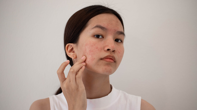 Woman with acne white tank top