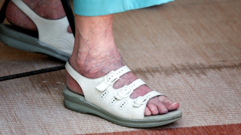 An elderly woman with orthopedic shoes