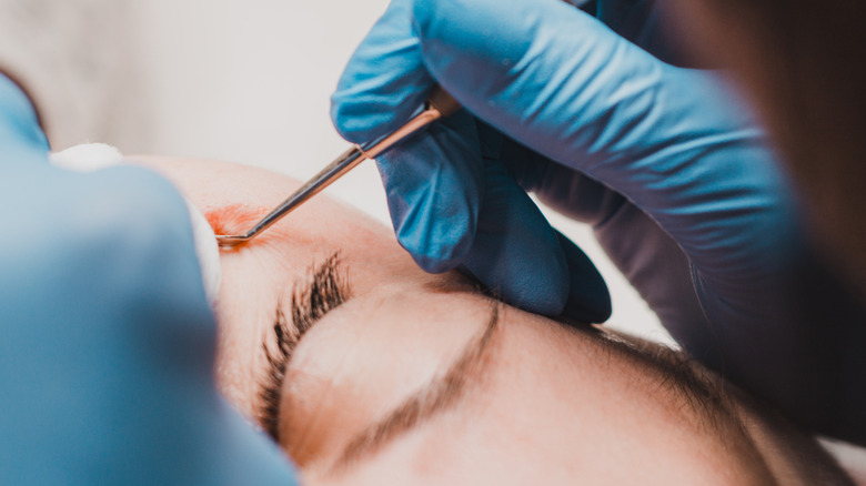 dermatologist performing milia extraction