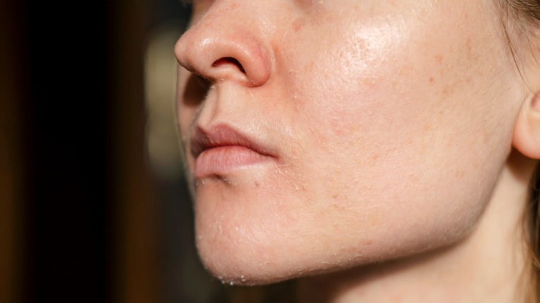 Woman with peeling dry skin