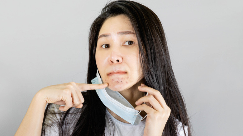 Woman reveal chin acne