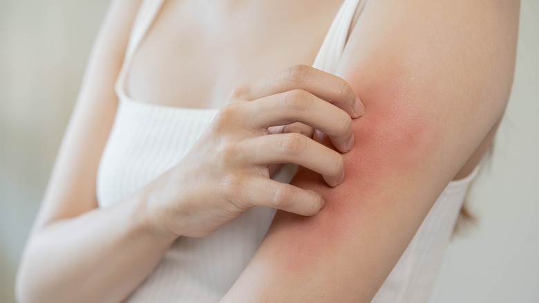Woman with eczema on her arm 
