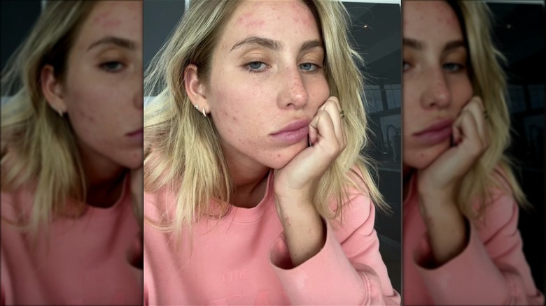 Alix Earle showing makeup-free acne