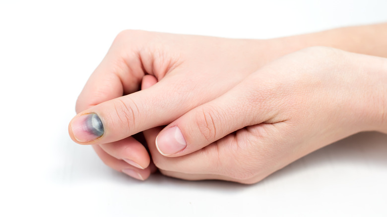 Hand with bruised nail