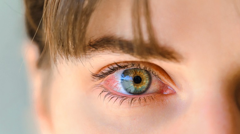 close up of woman with dry eyes